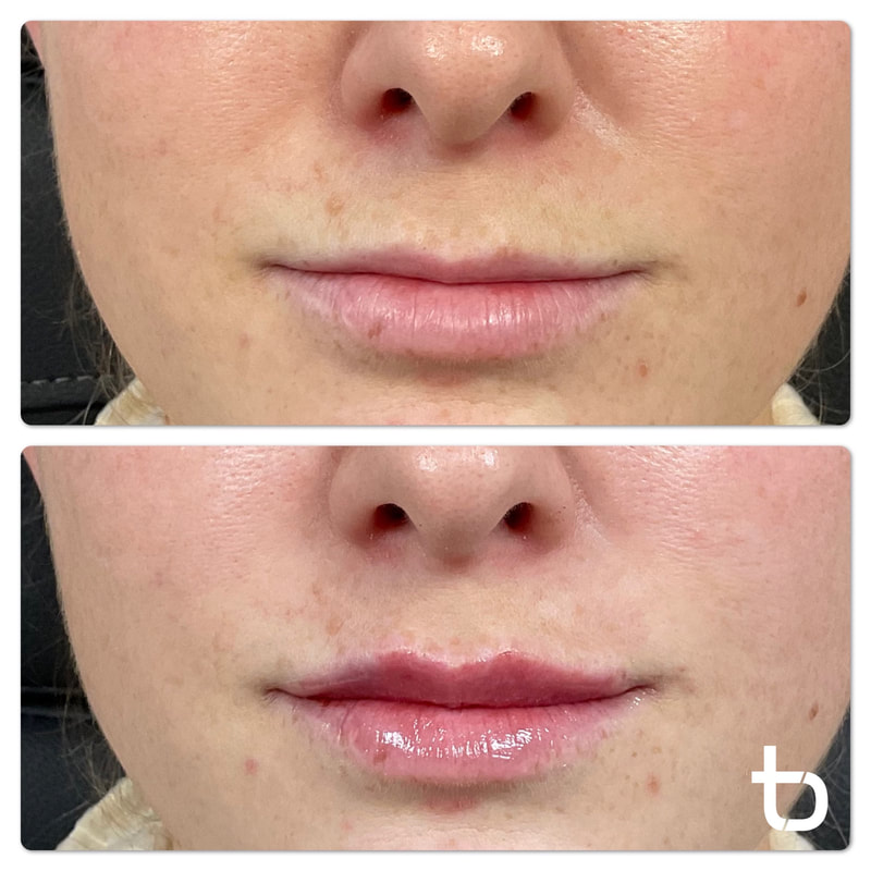 Before and after pictures of a client who wanted lip filler in their upper lip.