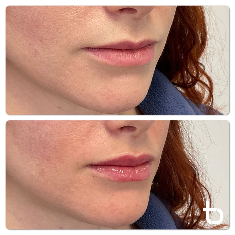 Subtle dermal lip filler to enhance your natural beauty.