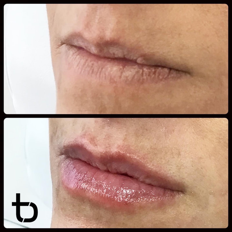Amazing before and after results for dermal lip filler!