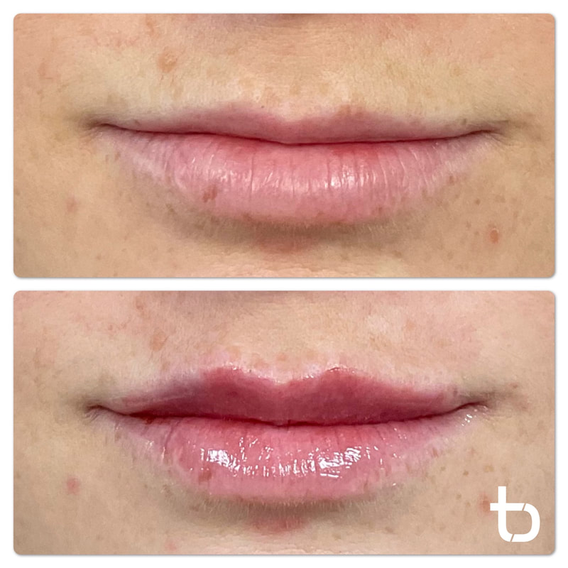 Picture of a client who got lip filler in their upper lip.