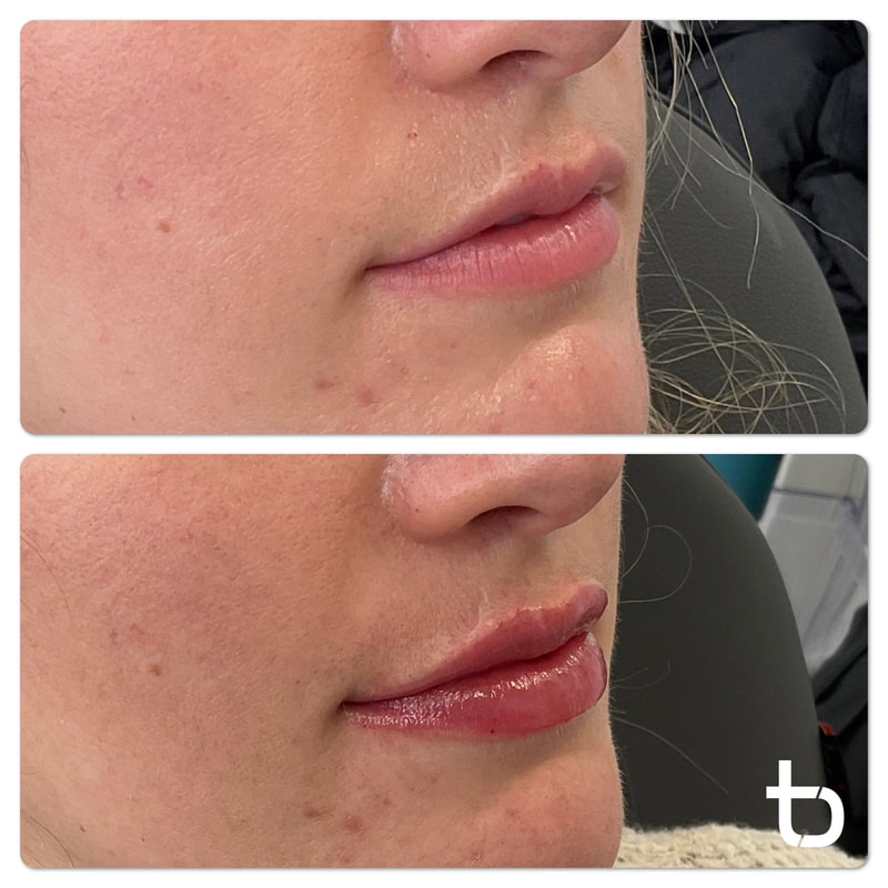 A client before and after getting lip filler from us.