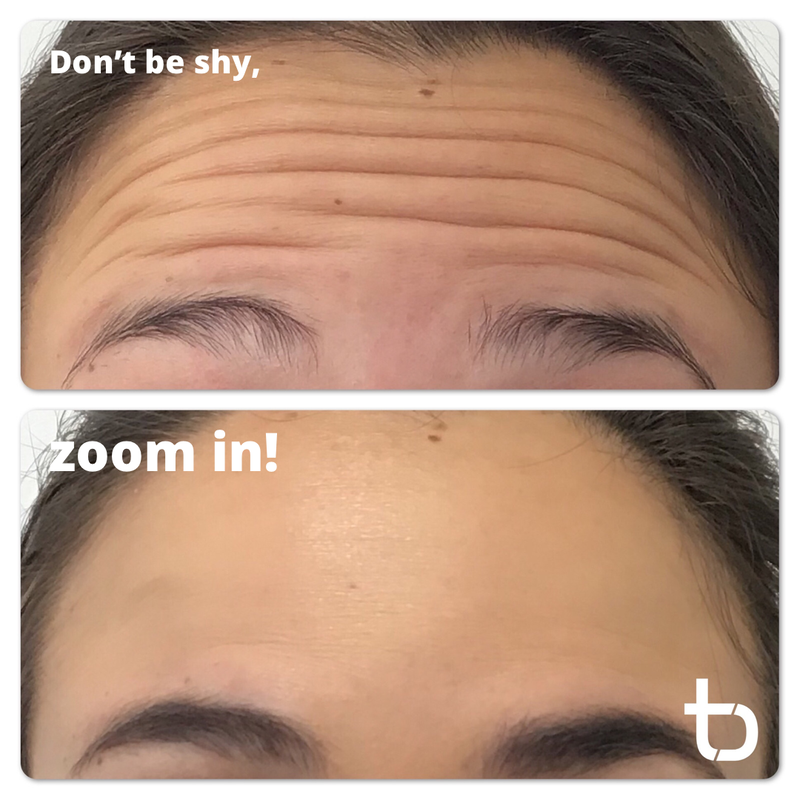 Zoom in to our clients forehead! She is wrinkle-free!