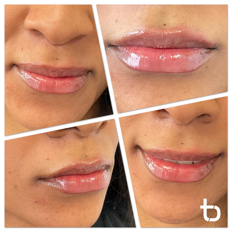 See how natural lip filler looks when you get it from Dam Med Spa.