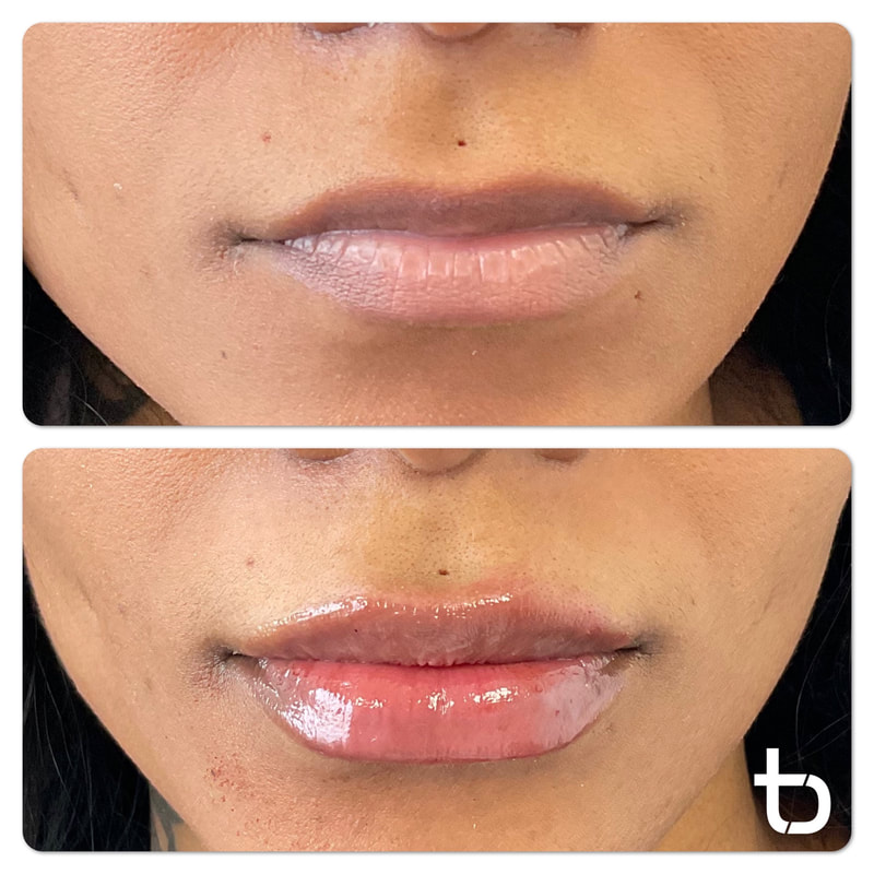 Visit our med spa for lip filler that looks natural!