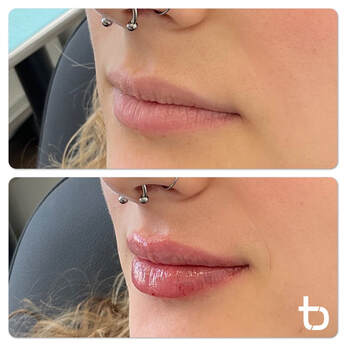 We offer subtle lip fillers that will enhance your natural beauty.
