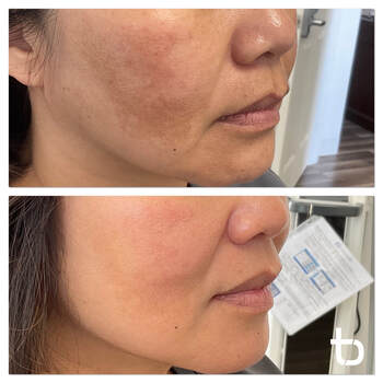 Need hyperpigmentation laser treatment? We offer this as a service!