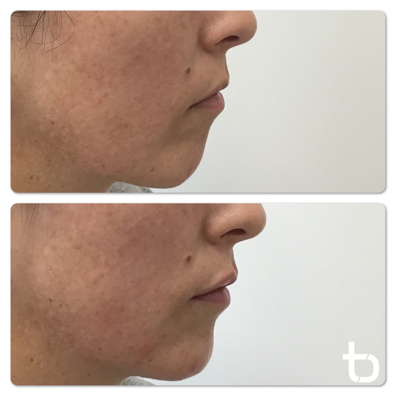 Proof that our lip fillers look natural!