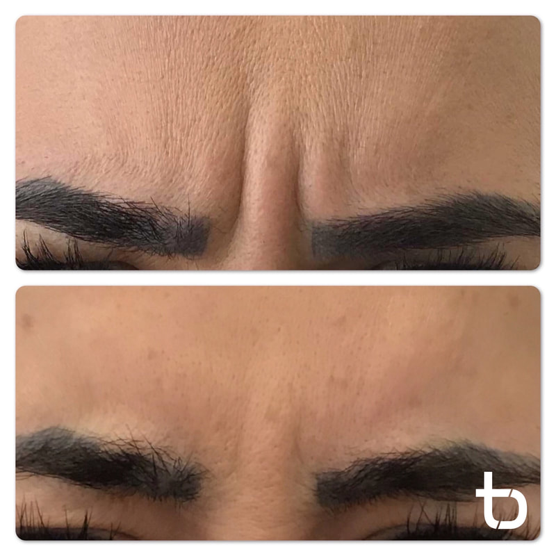 Botox can lessen the wrinkles between your eyebrows.