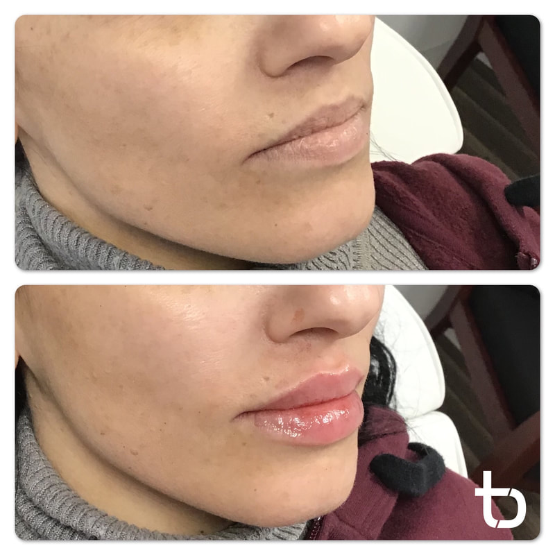 Side profile of client with lip filler.