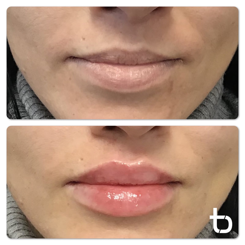 What lips look like before and after a lip filler treatment.