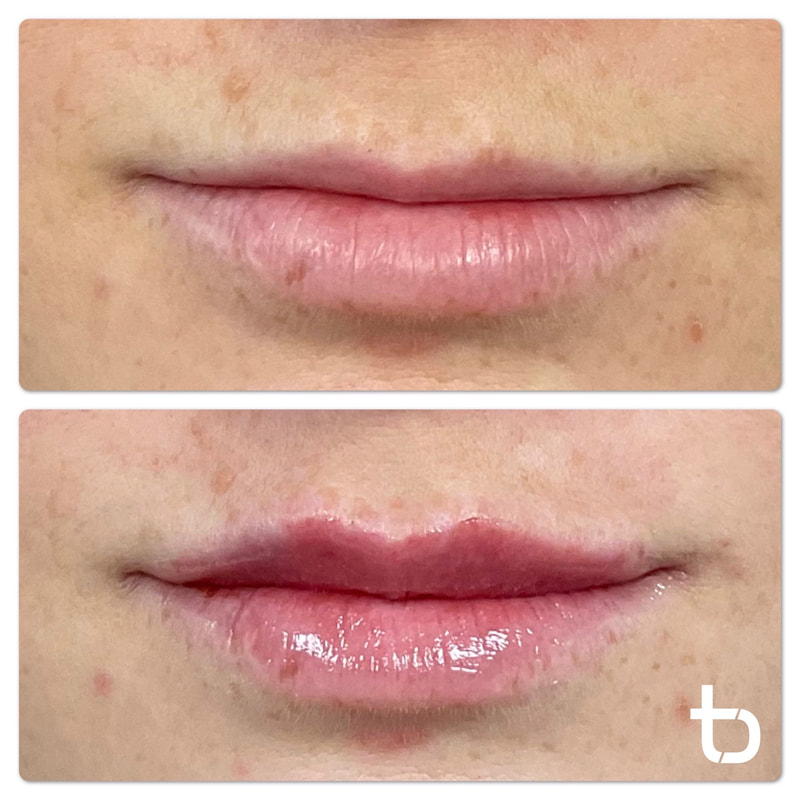 Lip filler results when you receive them from Dam Med Spa.
