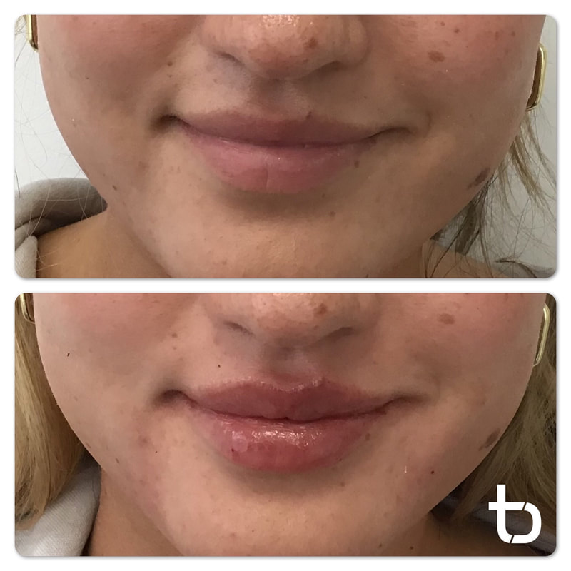 Smiling client with lip filler.