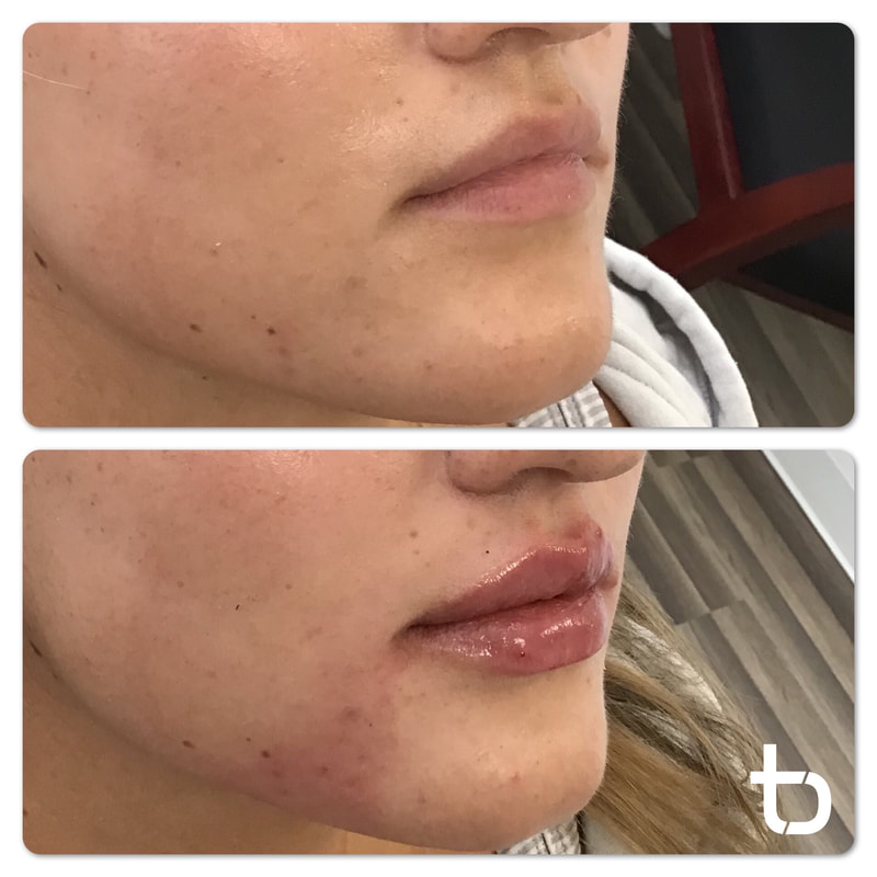 Photo of a clients' lips after they received dermal lip filler.