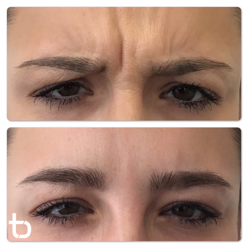 Reduce wrinkles between your eyebrows with botox.