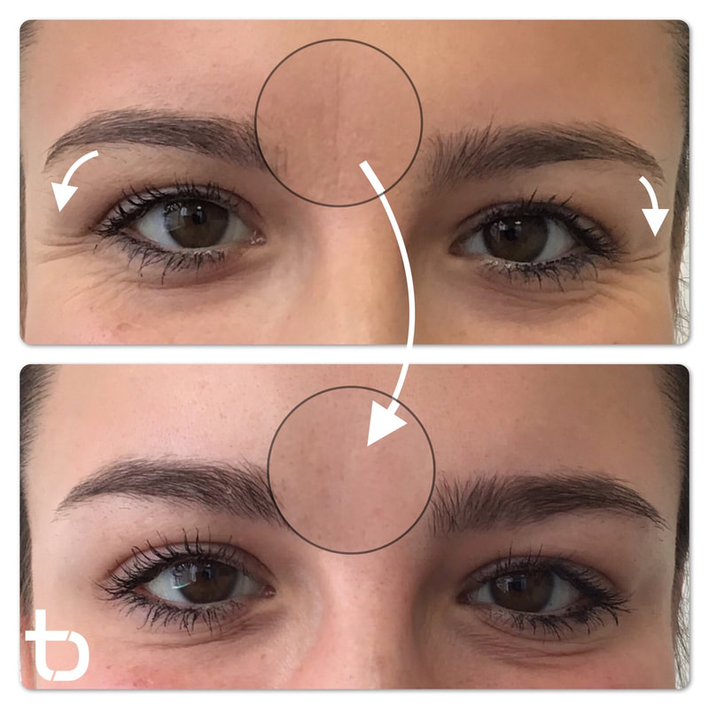 See how botox can reduce fine lines.