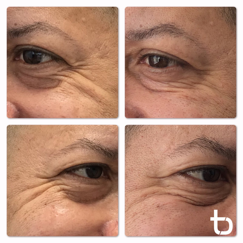 Botox around the eyes will decrease wrinkles.