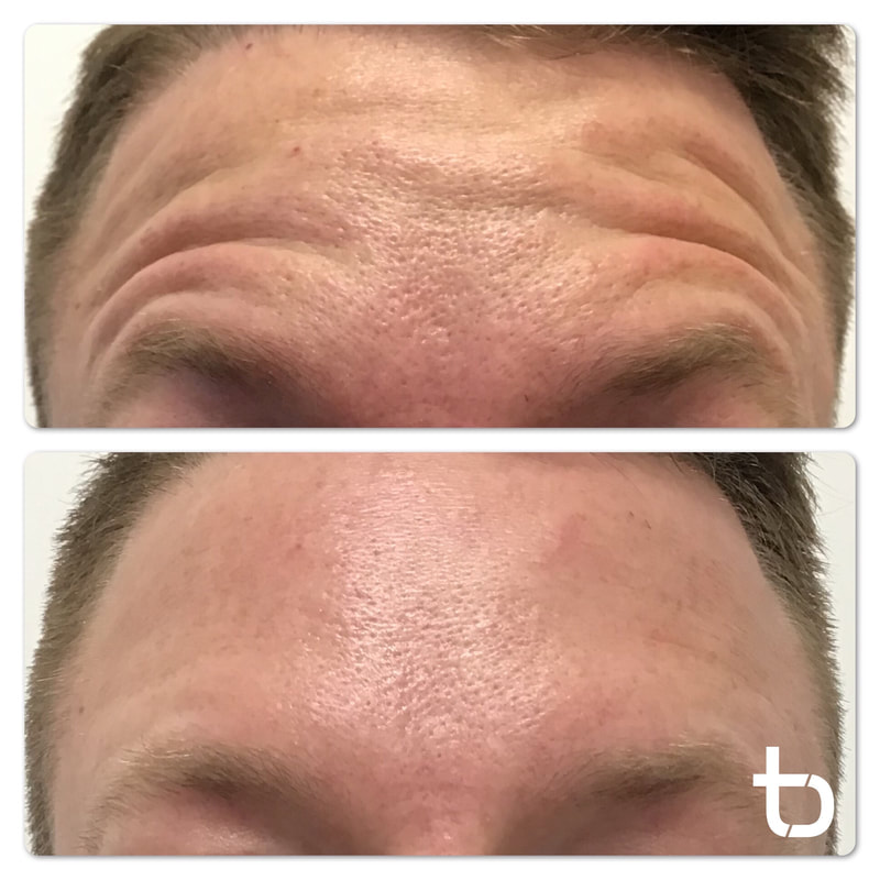 Decrease forehead wrinkles with botox.