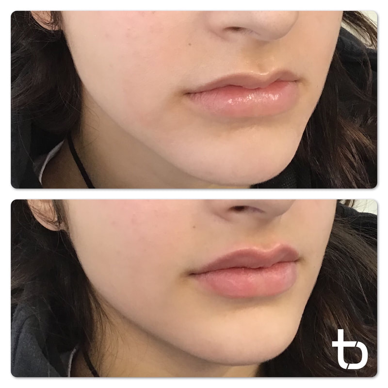 Before and after images focused on lips with lip filler.