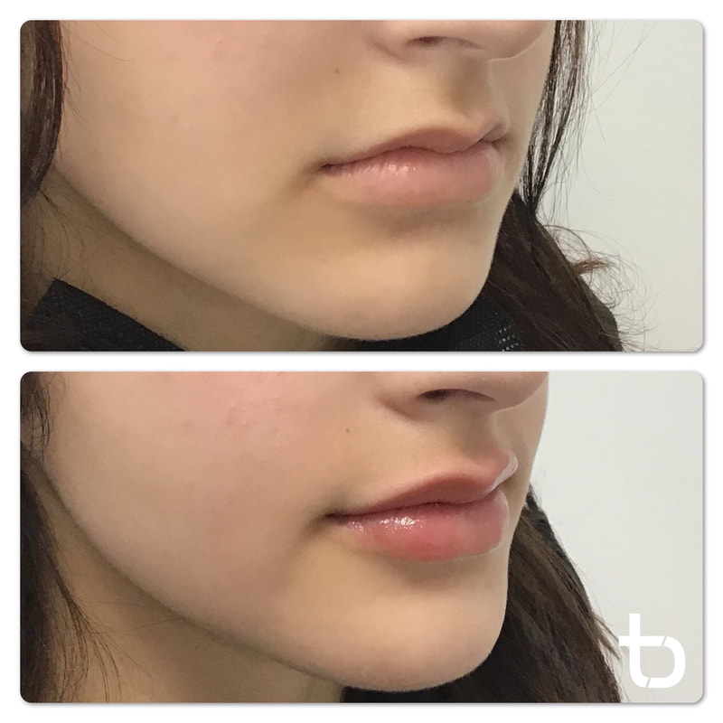 Side profile of a happy client with lip filler.
