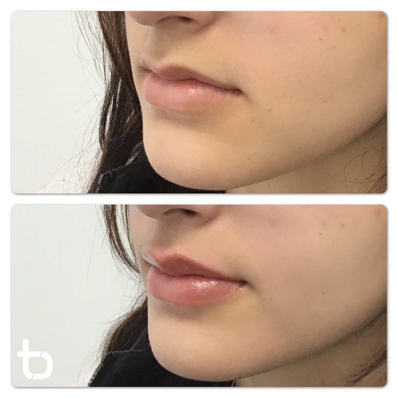 Amazing lip filler results.
