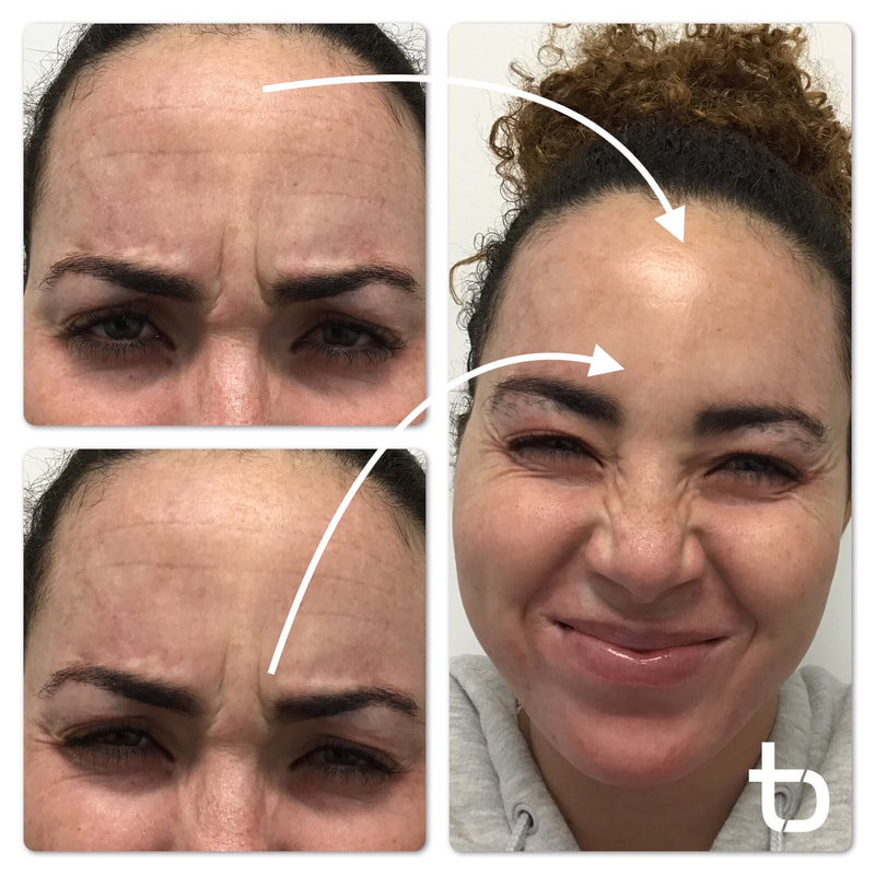 See how much younger our client looks after receiving botox treatment.