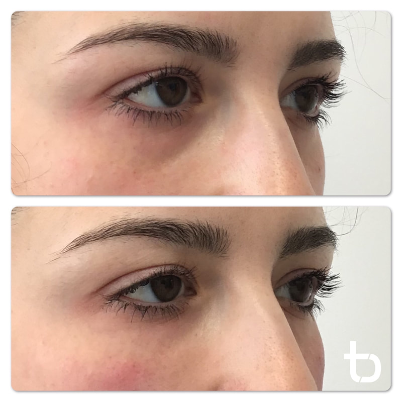 Under eye filler: before and after.
