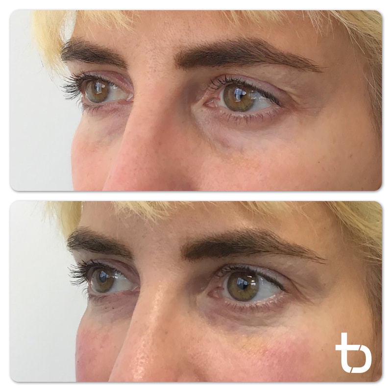 Before and after results of our client who received treatment around their eyes.