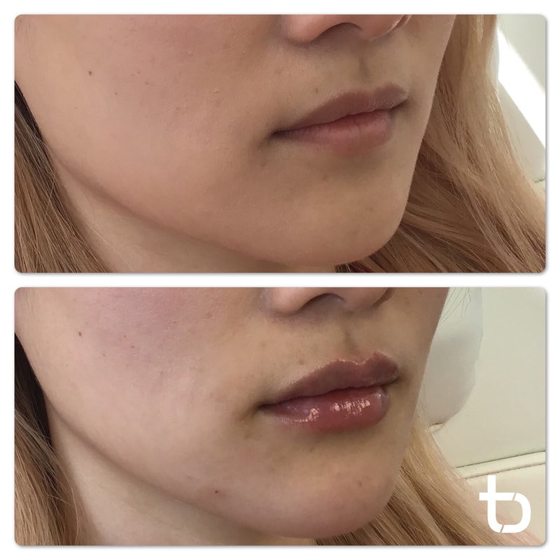 The remarkable results of lip filler.