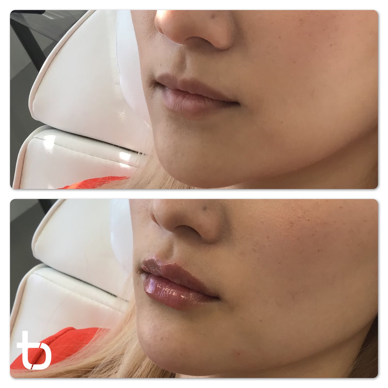 What lip filler looks like: before and after.