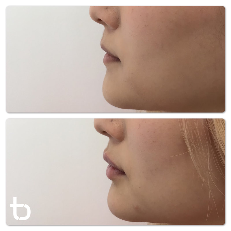 Our clients' lip filler results.
