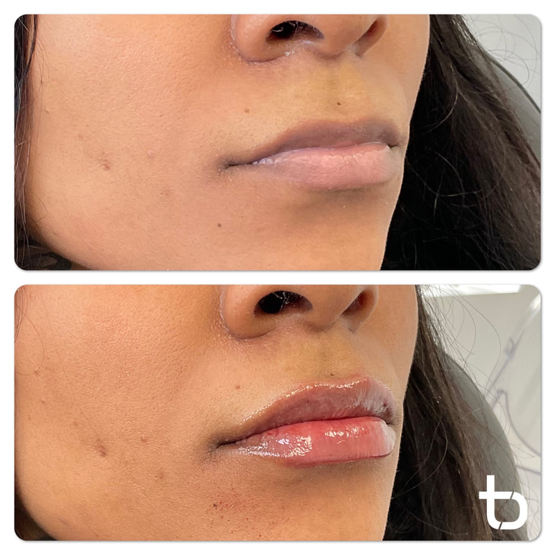 Lip filler pictures so you can see the before and after.