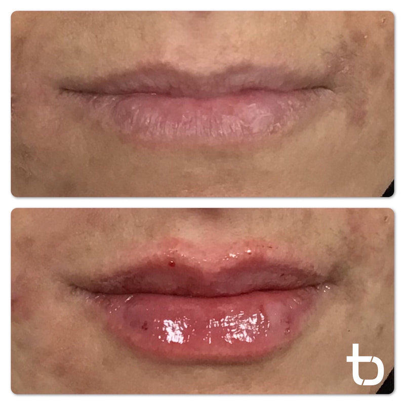 The outstanding results of lip filler.