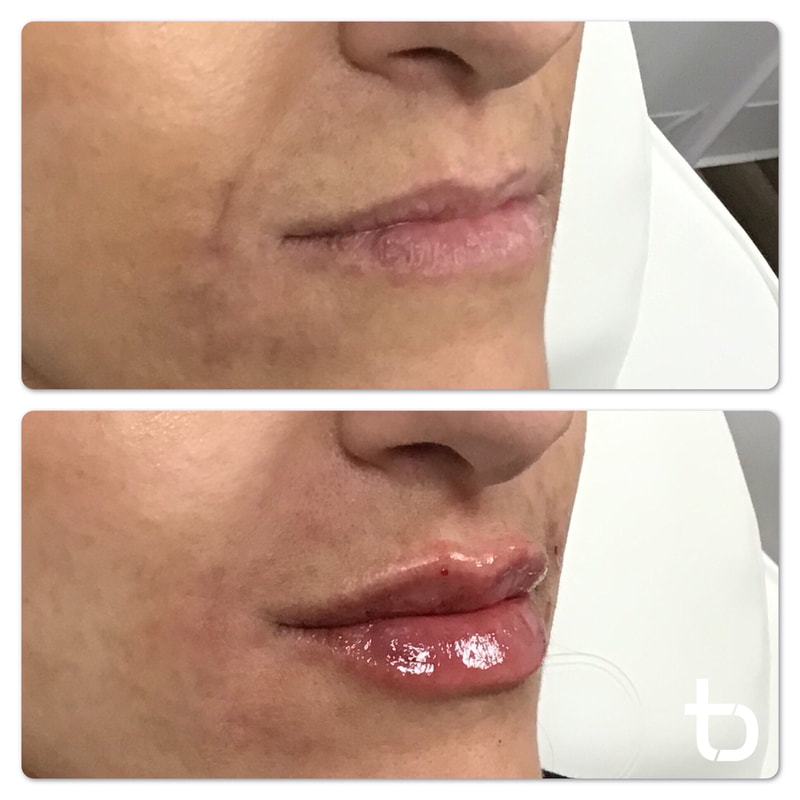 Photo of lips before and after lip filler.