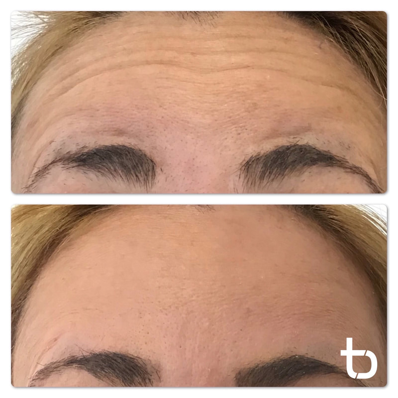 What botox in the forehead looks like (before and after photos).